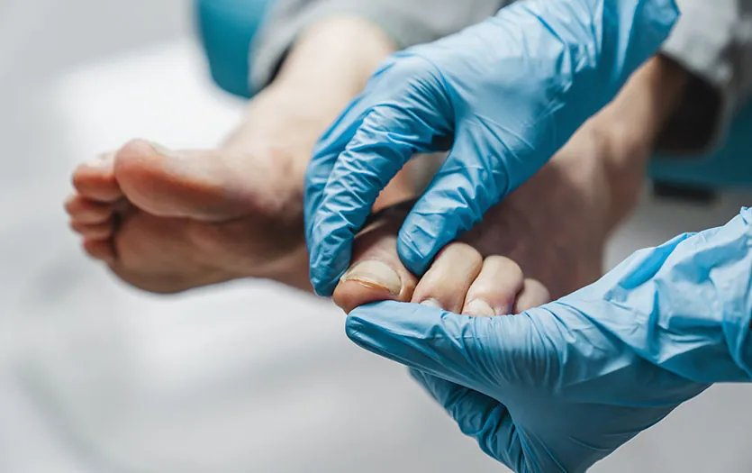 Fungal nail treatment